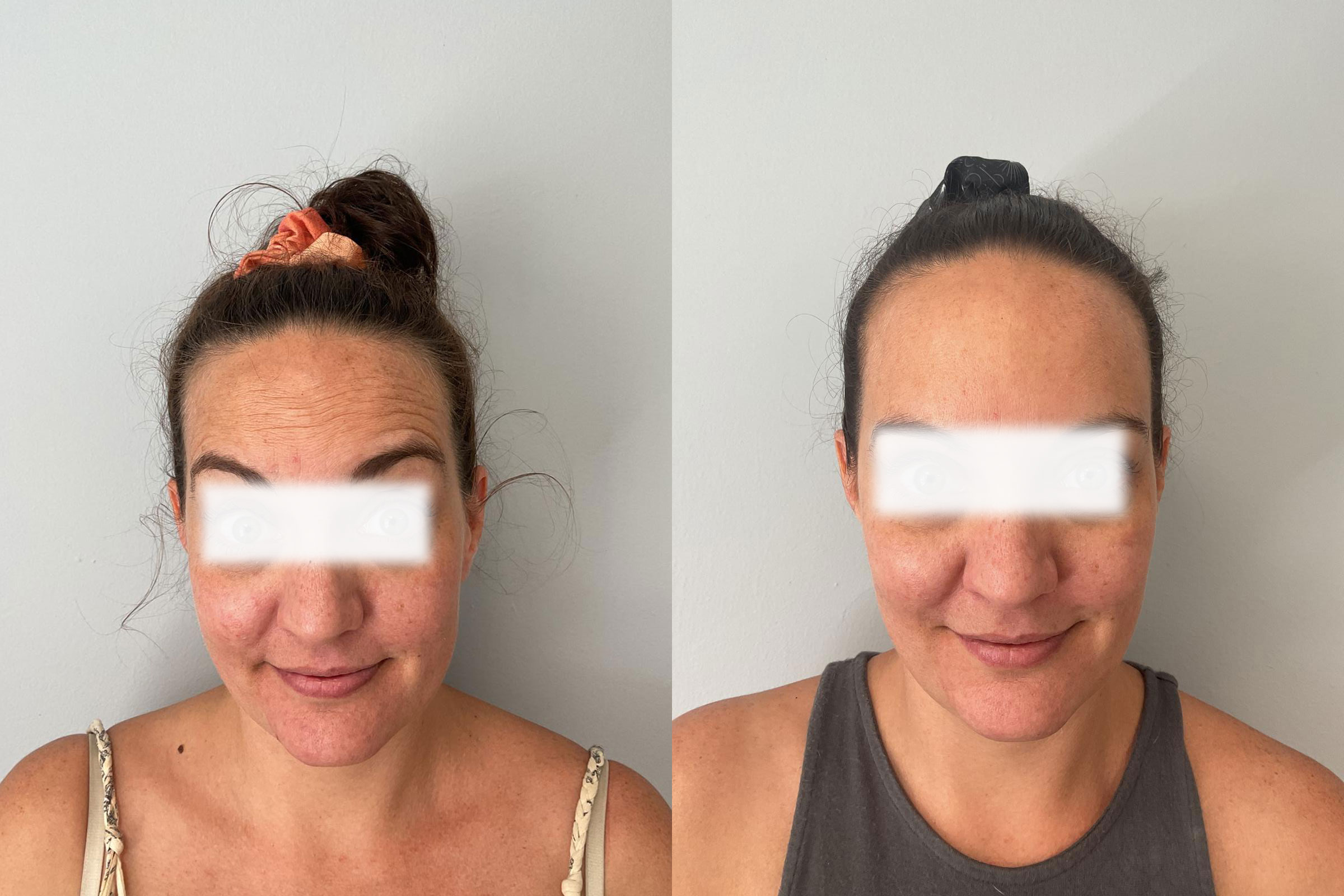 Botox2