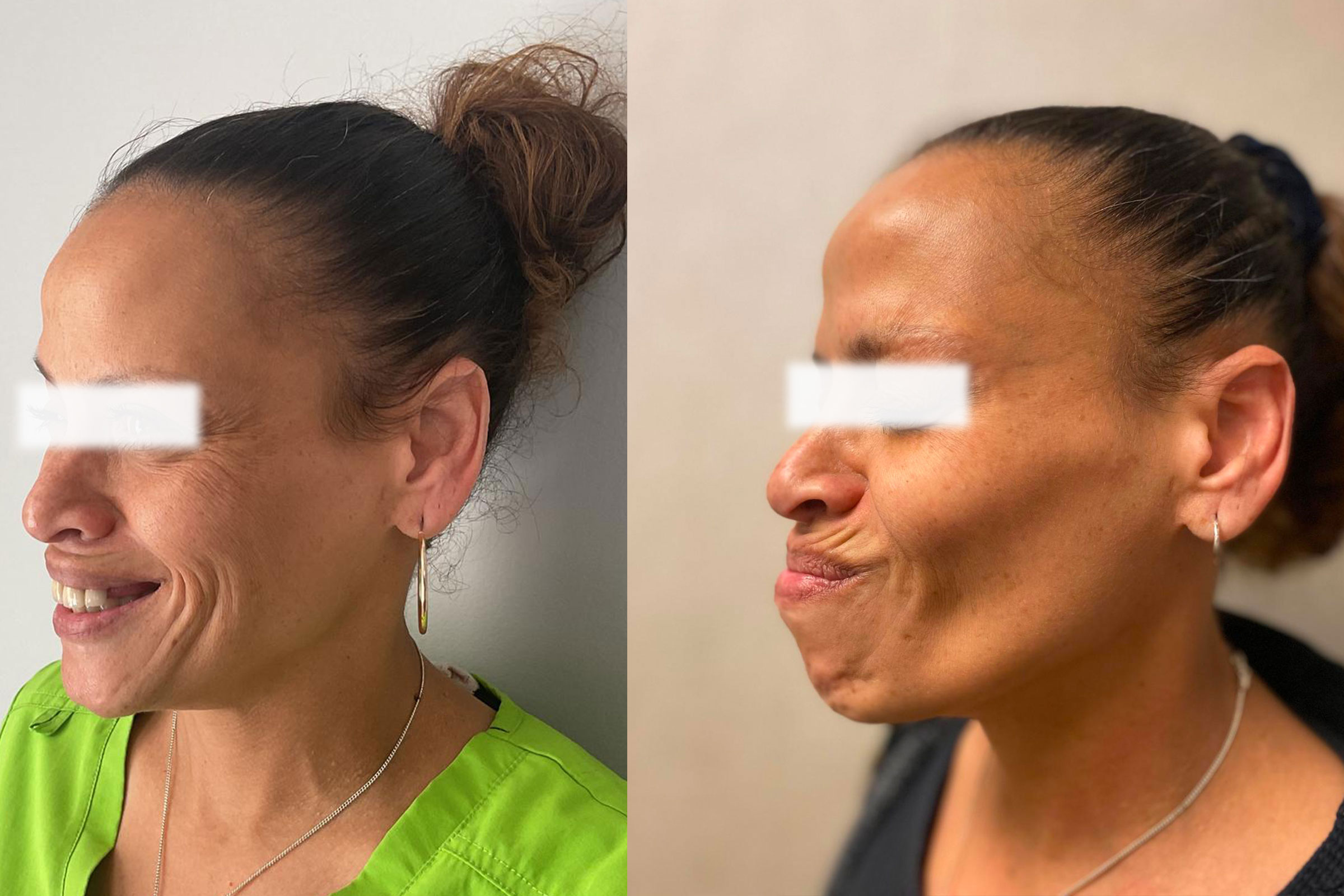 Botox3