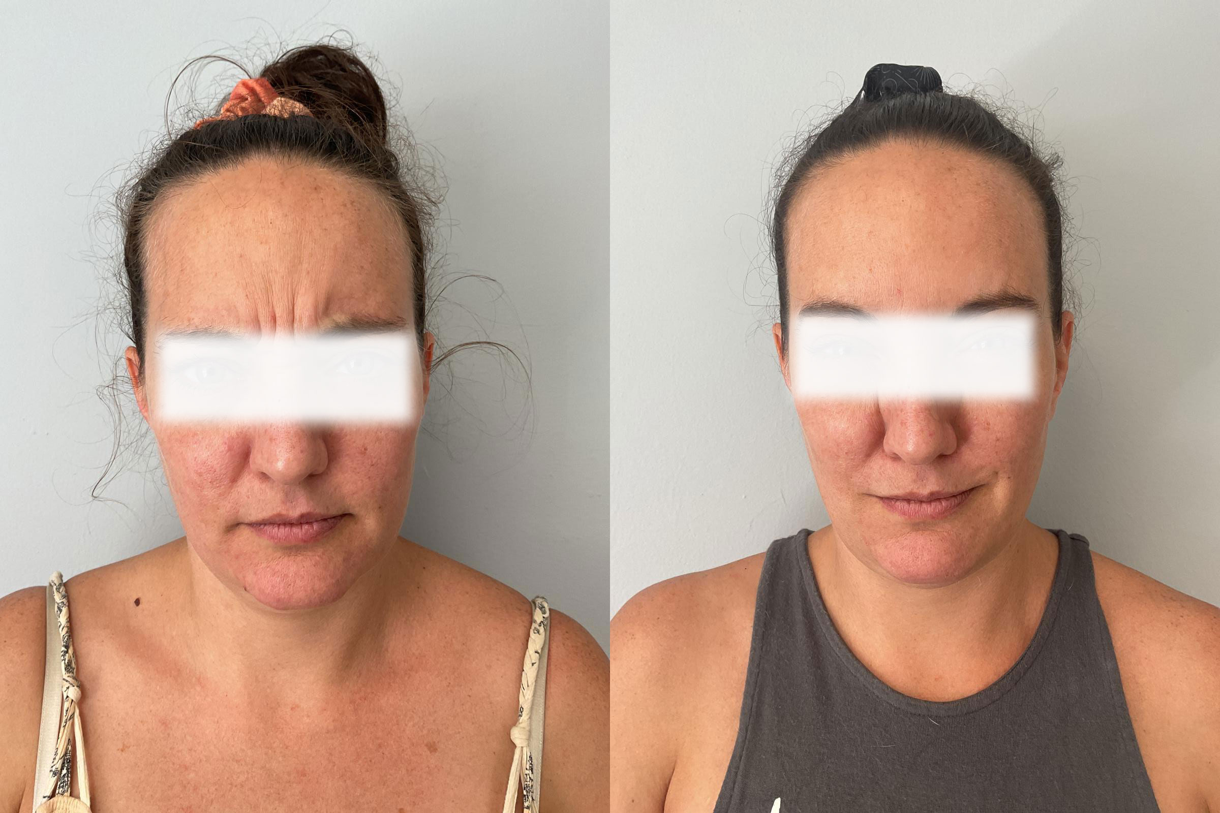 botox1
