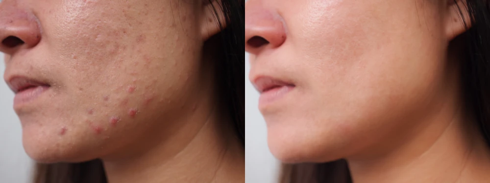 Before and after acne improvement with chemical peels.