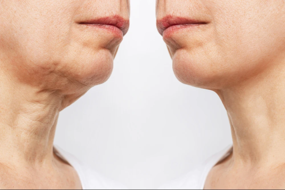 Side-by-side before and after results of dermal filler application to the lower face.