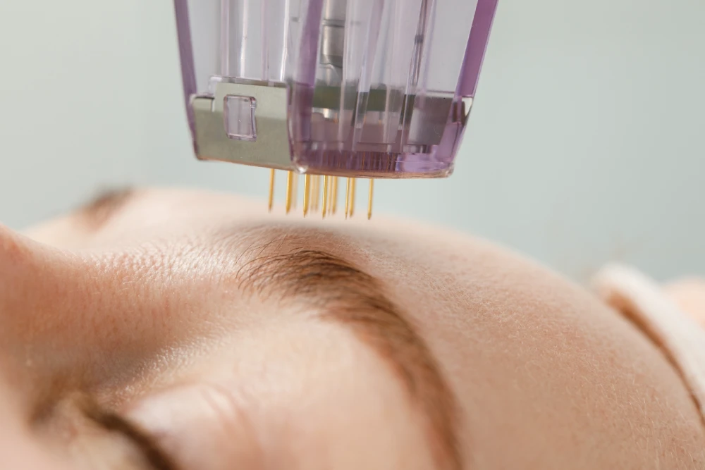 Close-up of a microneedling device during treatment.