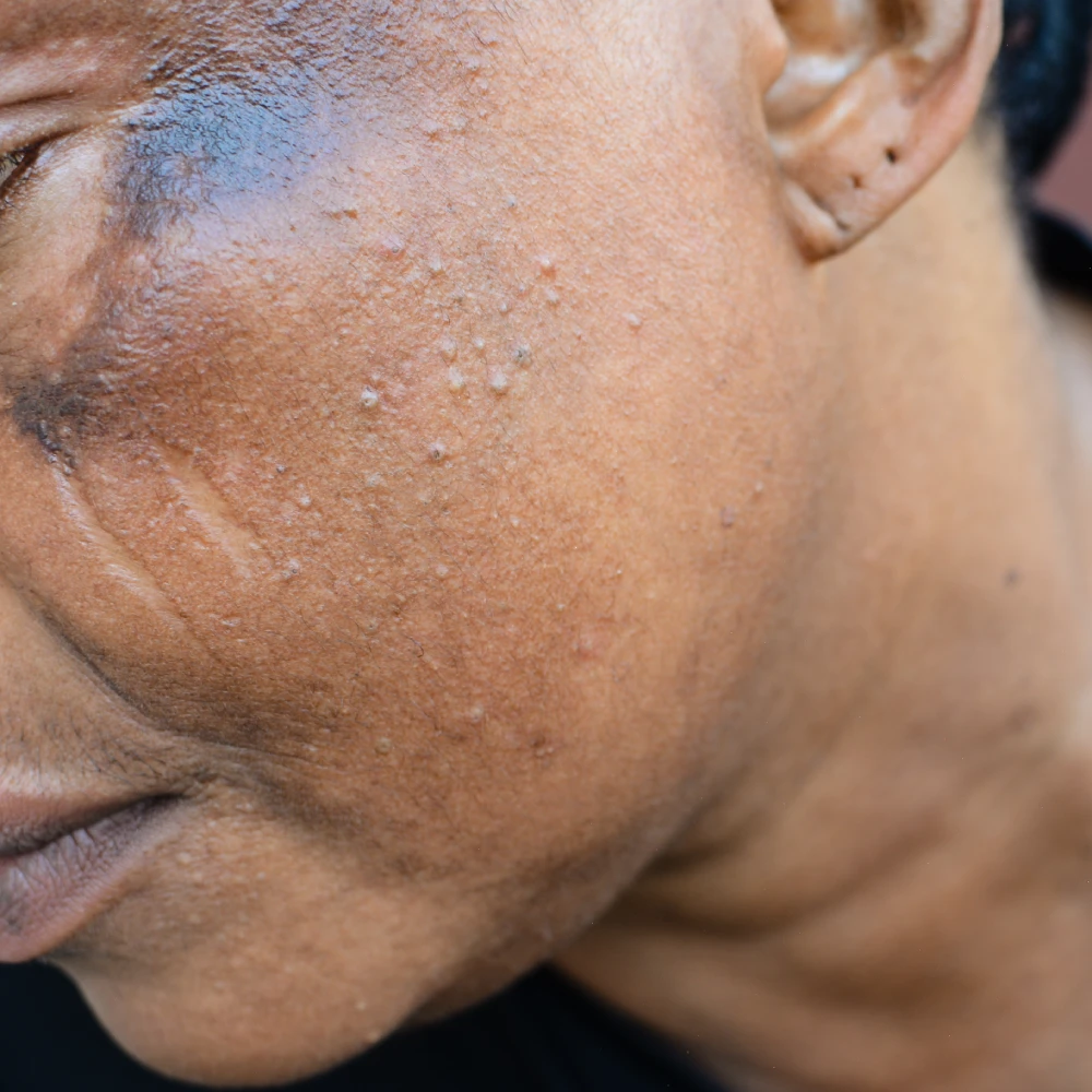 Close-up of hyperpigmented skin in need of laser skin resurfacing.