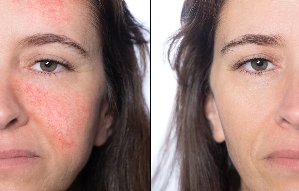 Before and after laser treatment for rosacea.